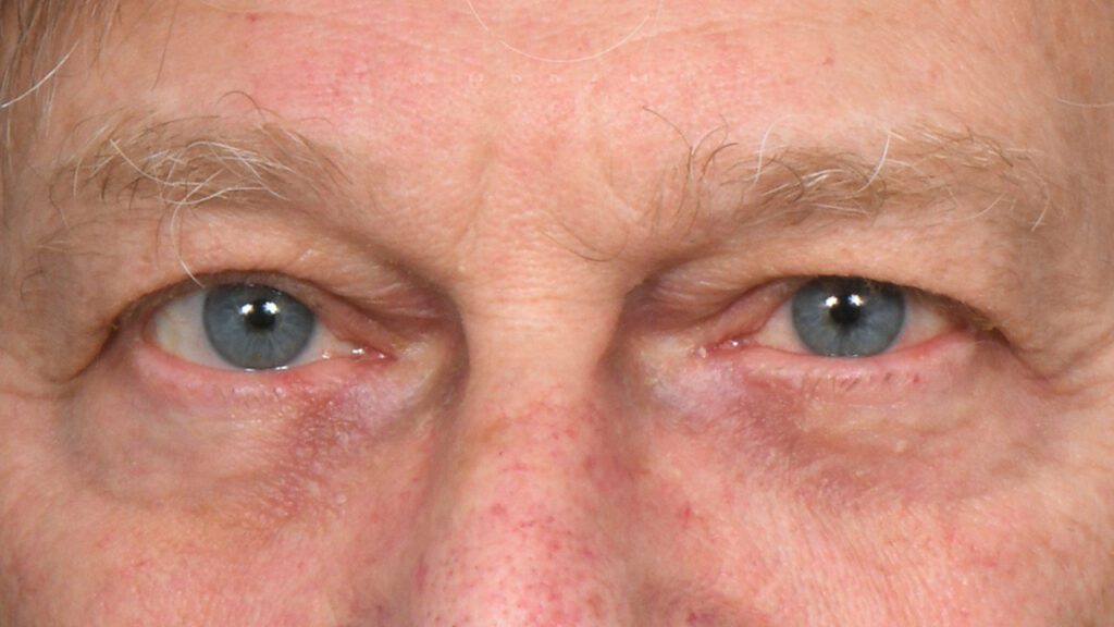 What Causes Undereye Bags and Dark Circles Under the Eyes, and How Can We Treat This?
