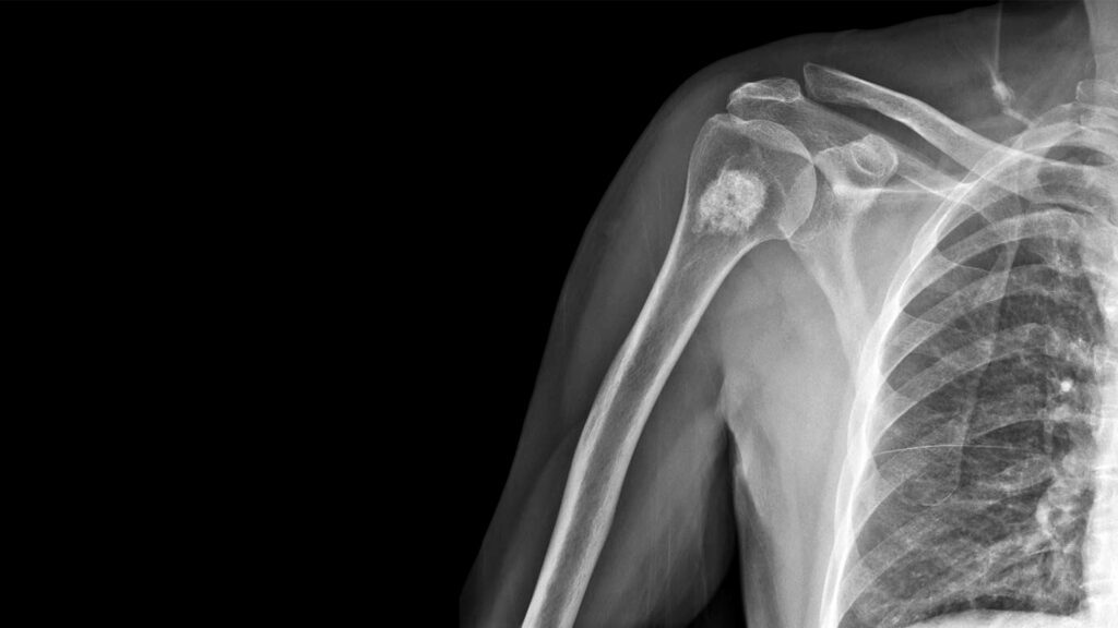 The Living Story of Bone: Beyond Calcium