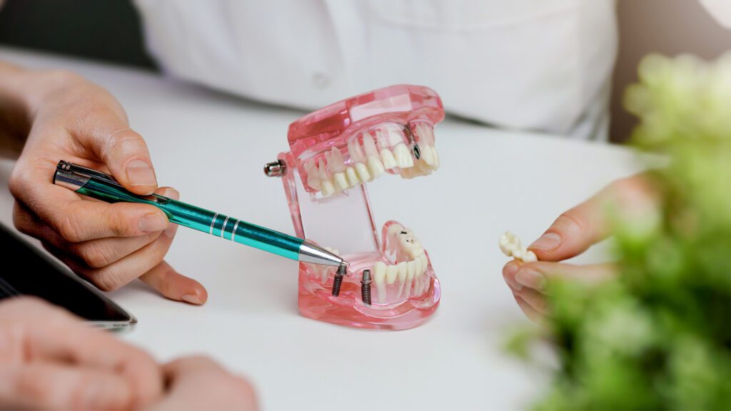 Considering Full-Arch Dental Implants? Questions You Should Ask Before You Choose an Implant Dentist