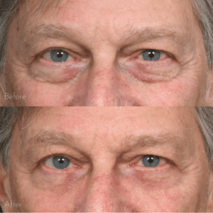 frontal eyes-Urban Facial Plastics