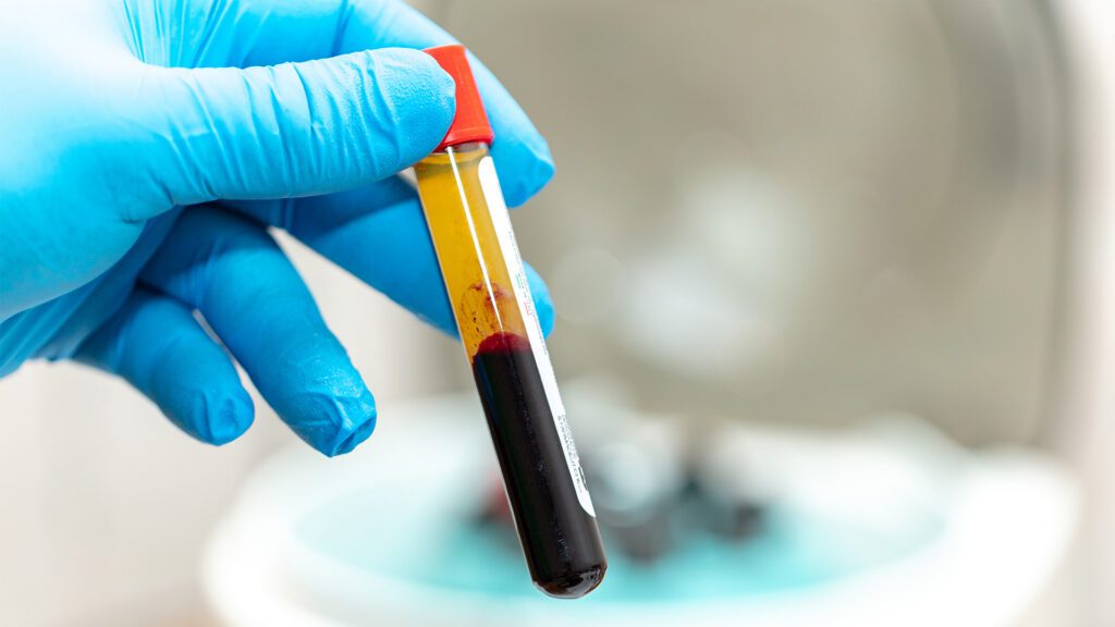 What Is PRP Therapy? A Natural Approach to Healing