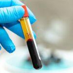 What Is PRP Therapy? A Natural Approach to Healing