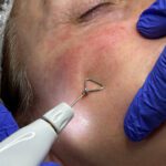 Healthy Skin Starts with Understanding Your Options: PRP Explained