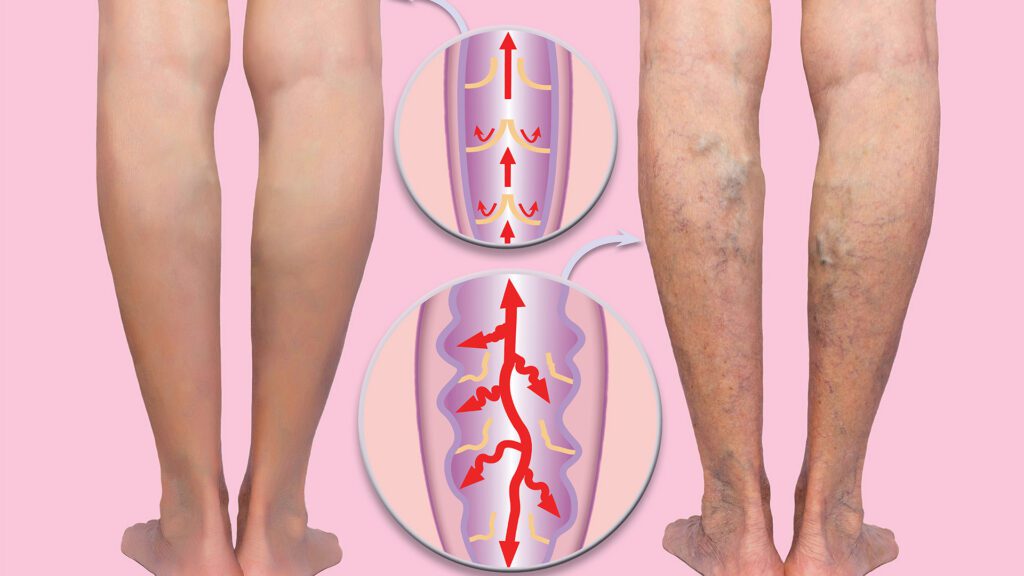 Understanding Venous Disease: My Approach to Helping Patients Find Relief and Restore Circulation
