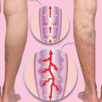 Understanding Venous Disease: My Approach to Helping Patients Find Relief and Restore Circulation