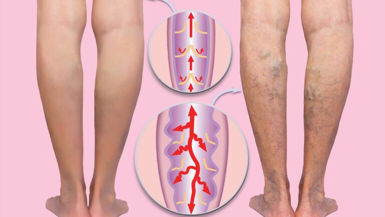 Understanding Venous Disease: My Approach to Helping Patients Find Relief and Restore Circulation