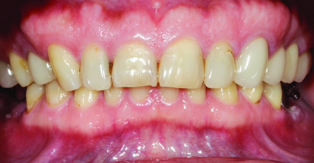 Deep Bite Blue Line Dental