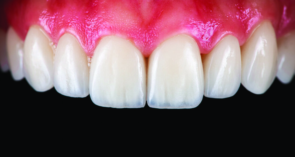 Veneers Blue Line Dental