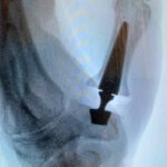 Thumb Basal Joint Arthritis: A Modern Solution That Gets Patients Back to Life
