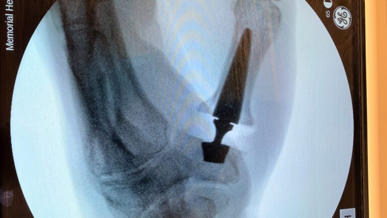 Thumb Basal Joint Arthritis: A Modern Solution That Gets Patients Back to Life