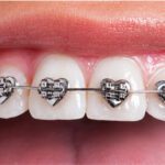 Early Orthodontic Intervention for Kids and the Benefits of WildSmiles® Custom Braces