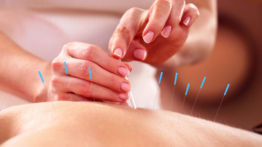 Acupuncture for Anxiety: A Modern Option at Mountain Mental Health