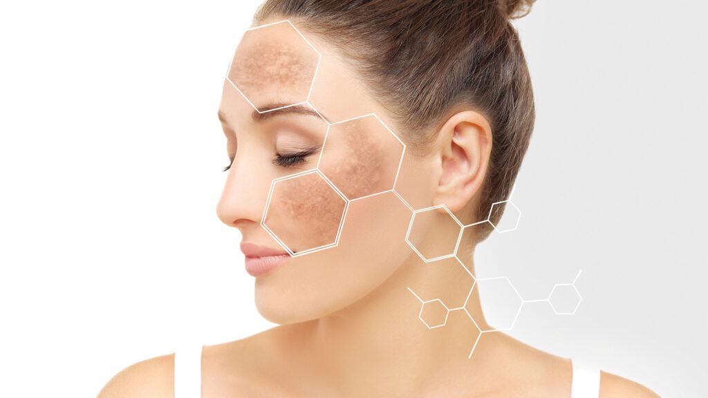 Understanding Hyperpigmentation and Melasma