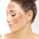 Understanding Hyperpigmentation and Melasma
