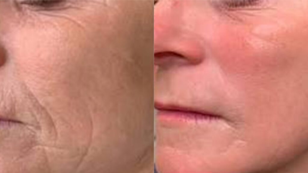 The Secret to Looking Younger Isn’t Changing Your Face—It’s Restoring What Time Has Taken Away
