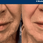 Why There Is No One-Size-Fits-All Cosmetic Treatment: A Personalized Approach to Aging Well
