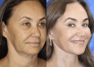 Art of Beauty MedSpa facelift before and after