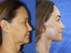 Art of Beauty MedSpa facelift before and after