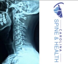 Carolina Spine and Health spine neck xray