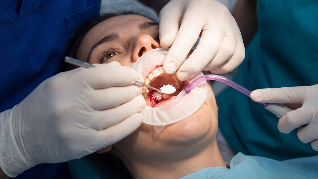 Why Bone Grafting is Often Recommended After a Tooth Extraction