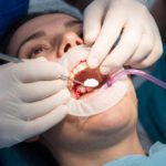 Why Bone Grafting is Often Recommended After a Tooth Extraction