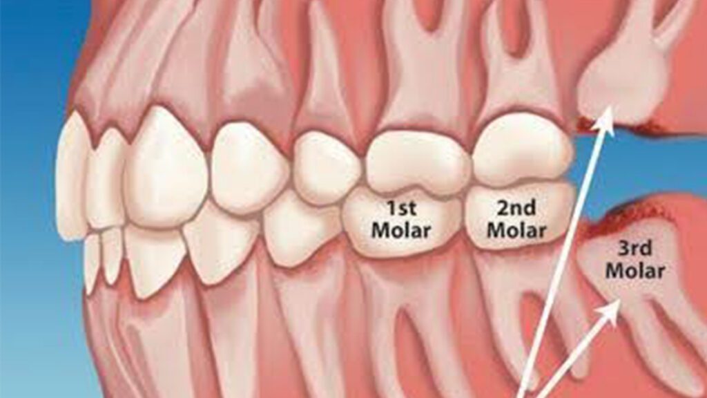 The Importance of Removing Impacted Third Molars (Wisdom Teeth)