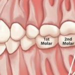 The Importance of Removing Impacted Third Molars (Wisdom Teeth) 