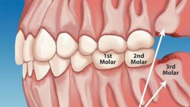 The Importance of Removing Impacted Third Molars (Wisdom Teeth)