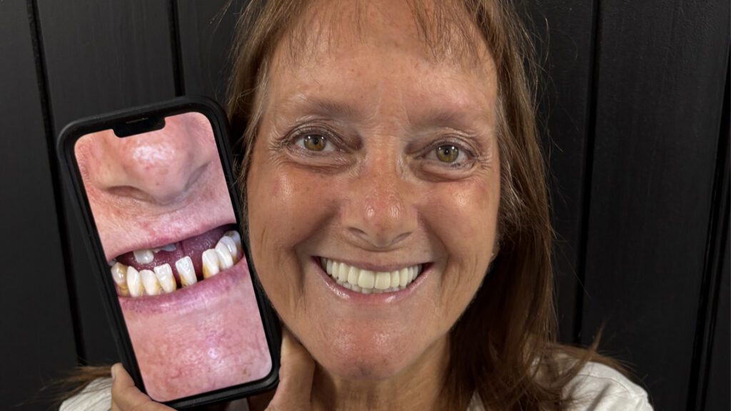 Ask the Expert: Why Should I Choose Dental Implants Instead of a Bridge, Dentures, or All-on-X?