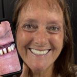 Ask the Expert: Why Should I Choose Dental Implants Instead of a Bridge, Dentures, or All-on-X?