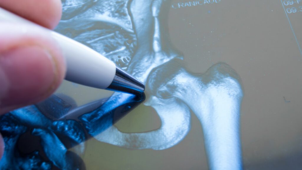 A New Approach to Hip Replacement Surgery Spares Muscles, Speeds Recovery