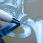 A New Approach to Hip Replacement Surgery Spares Muscles, Speeds Recovery