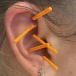 Battlefield Acupuncture: A Modern Approach to Pain Relief