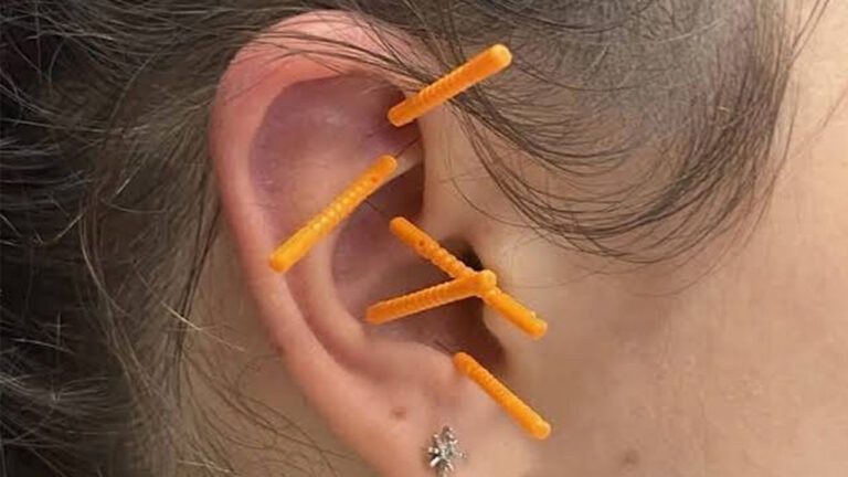 Battlefield Acupuncture: A Modern Approach to Pain Relief