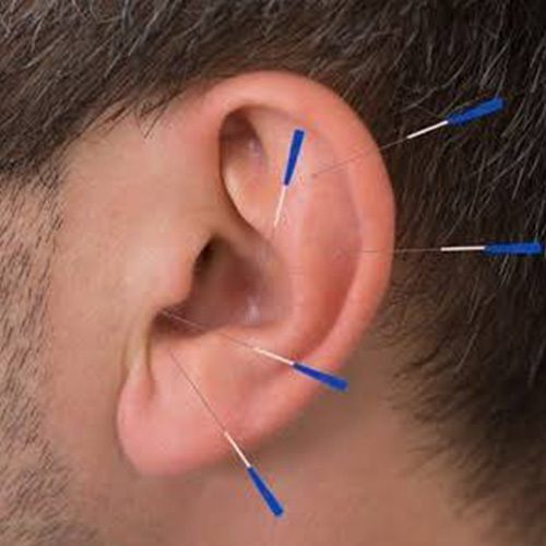 Battlefield acupuncture man Wagner Chiropractic, LLC