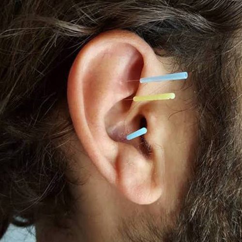 Battlefield acupuncture man ear Wagner Chiropractic, LLC