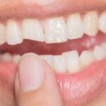 Why Teeth Fail and How We Decide What Will Save Them