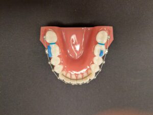 Greeley Orthodontics retainer molds