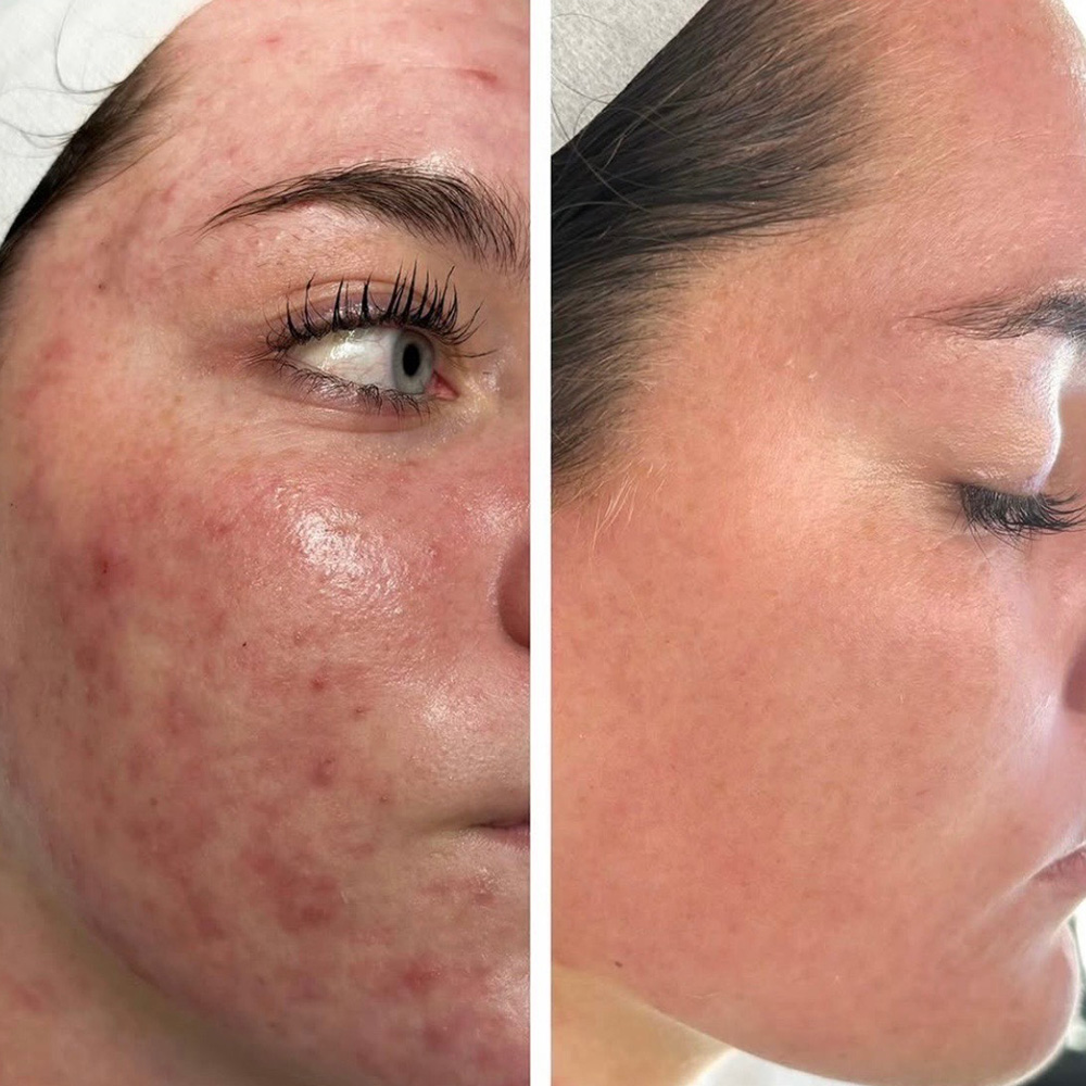 Facial treatment before and after The Rural Aesthetic Med Spa