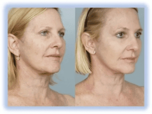 Hinkle Group LLC before and after