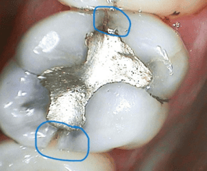 Mequon Smile Design tooth crown