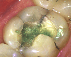 Mequon Smile Design cracked tooth