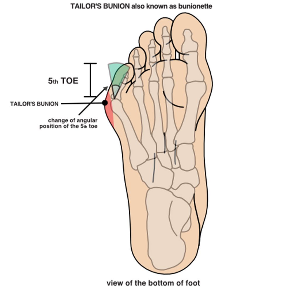 Tailor's Bunion Graphic Sunshine Ankle and Foot Experts