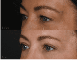 Urban Facial Plastics before and after eyelid surgery