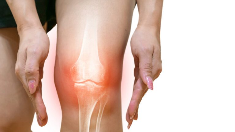 How EMSCULPT NEO® Can Help Support Painful Joints