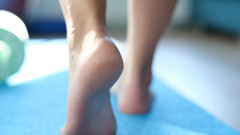 Calluses: When You Should See a Podiatrist