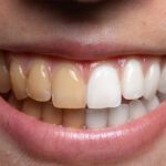 What Cannabis Use Means for Your Mouth