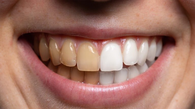 What Cannabis Use Means for Your Mouth