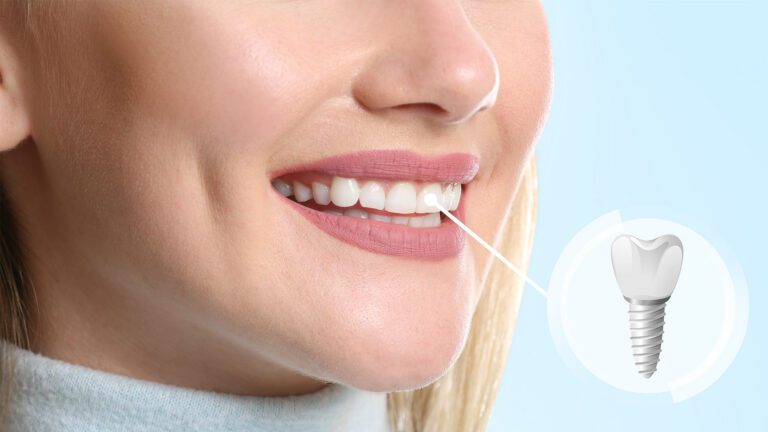 Should I Stay or Should I Go Now… (Tooth Edition)